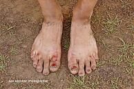 Anton's battered feet...